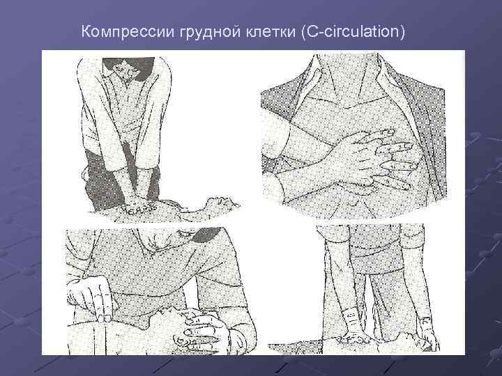 Компрессии грудной клетки (C-circulation) 