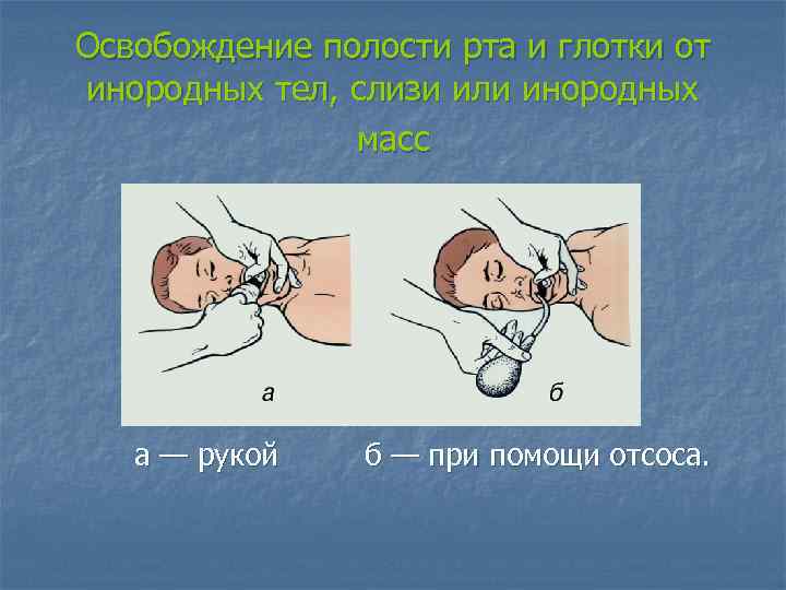 Освобождение полости рта и глотки от инородных тел, слизи или инородных масс а —