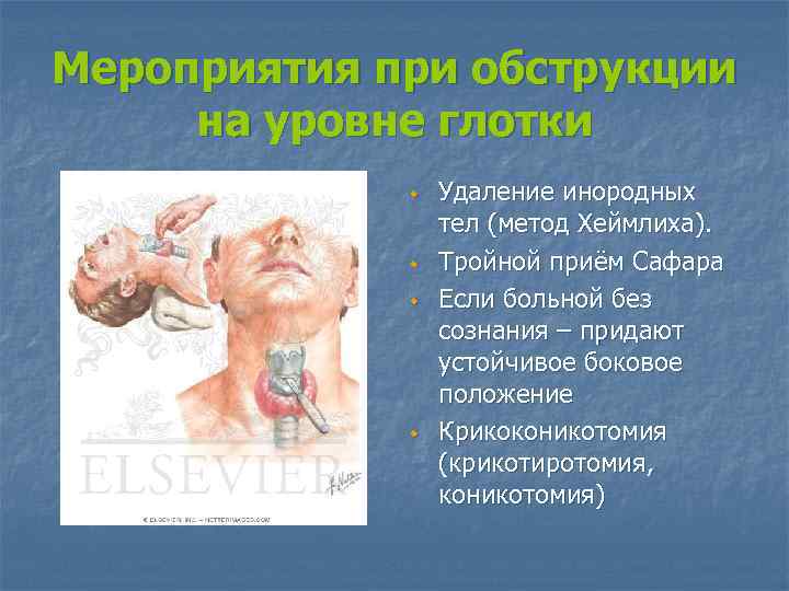 Мероприятия при обструкции на уровне глотки w w Удаление инородных тел (метод Хеймлиха). Тройной