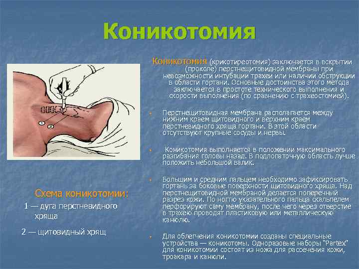 Коникотомия (крикотиреотомия) заключается в вскрытии (проколе) перстнещитовидной мембраны при невозможности интубации трахеи или наличии