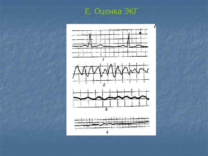 E. Оценка ЭКГ 