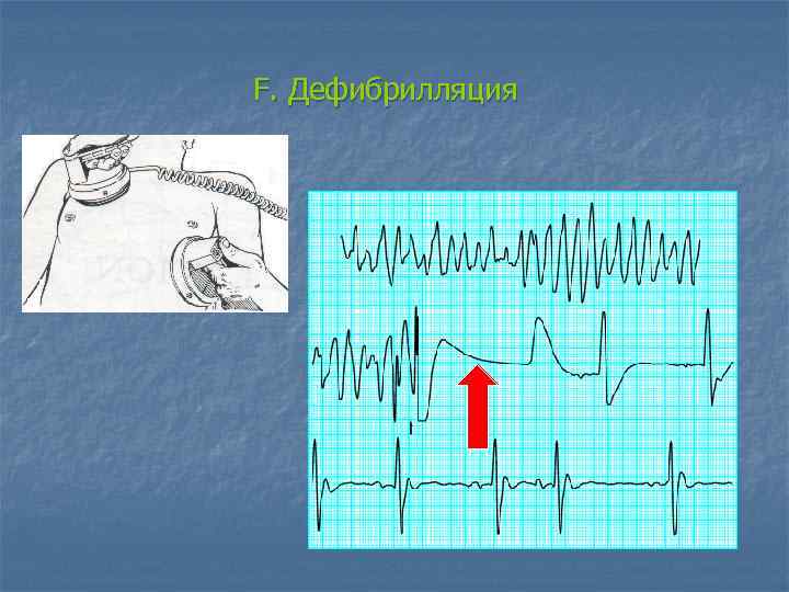 F. Дефибрилляция 