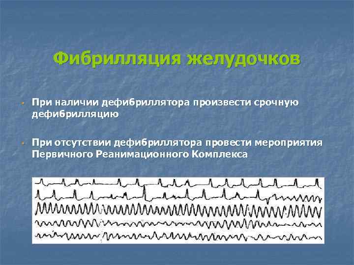 Фибрилляция желудочков w w При наличии дефибриллятора произвести срочную дефибрилляцию При отсутствии дефибриллятора провести