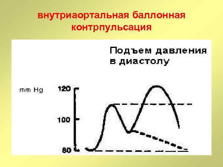 внутриаортальная баллонная контрпульсация 