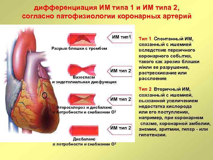 дифференциация ИМ типа 1 и ИМ типа 2, согласно патофизиологии коронарных артерий ИМ тип