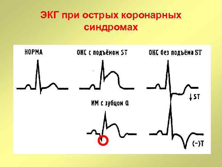 Острый инфаркт миокарда без подъема st