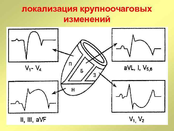 локализация крупноочаговых изменений 