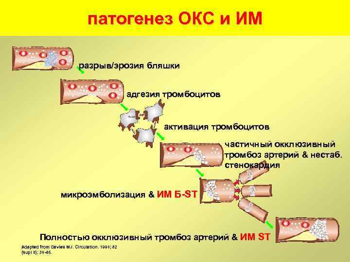 патогенез ОКС и ИМ разрыв/эрозия бляшки адгезия тромбоцитов активация тромбоцитов частичный окклюзивный тромбоз артерий