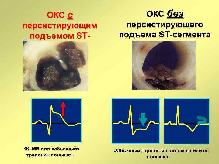 ОКС с персистирующим подъемом STсегмента КК–МБ или «обычный» тропонин повышен ОКС без персистирующего подъема