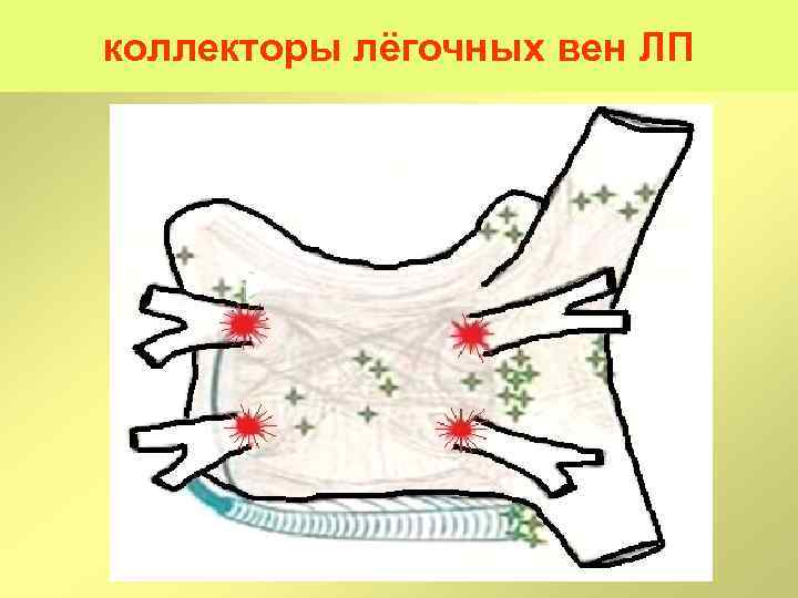 коллекторы лёгочных вен ЛП 