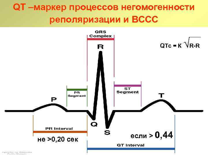 QT –маркер процессов негомогенности реполяризации и ВССС QTс = К не ˃0, 20 сек