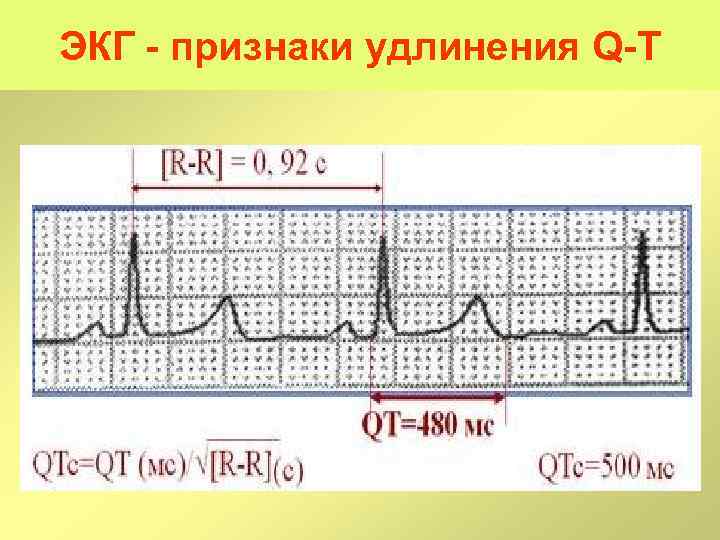 ЭКГ признаки удлинения Q T 