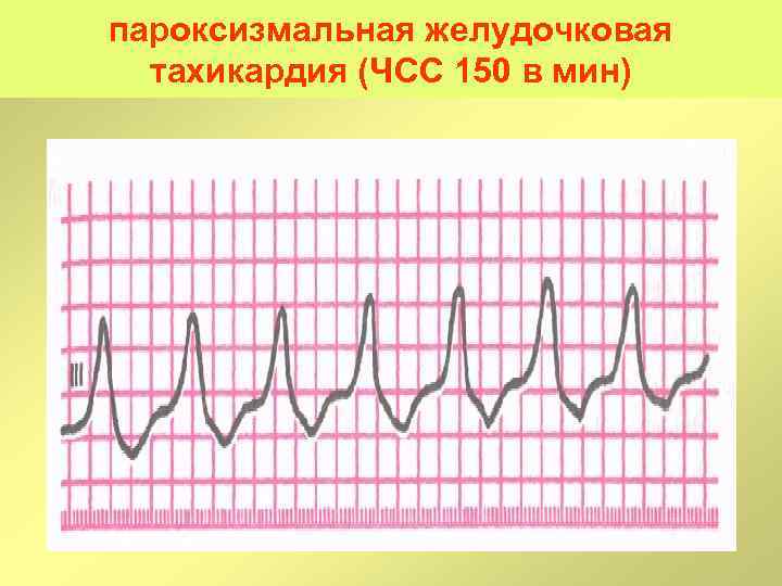 пароксизмальная желудочковая тахикардия (ЧСС 150 в мин) 