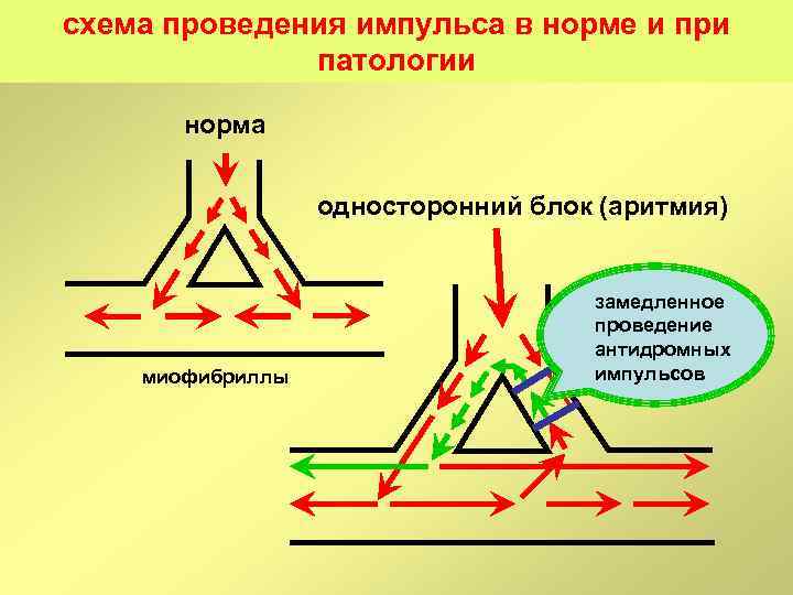 схема проведения импульса в норме и при патологии норма односторонний блок (аритмия) миофибриллы замедленное