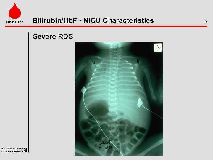 RED SYSTEM™ Bilirubin/Hb. F - NICU Characteristics Severe RDS 30 