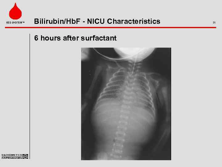 RED SYSTEM™ Bilirubin/Hb. F - NICU Characteristics 6 hours after surfactant 31 