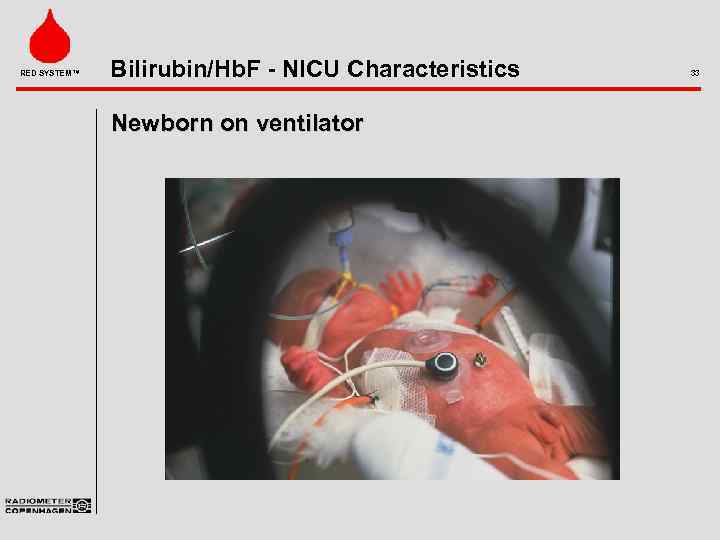 RED SYSTEM™ Bilirubin/Hb. F - NICU Characteristics Newborn on ventilator 33 