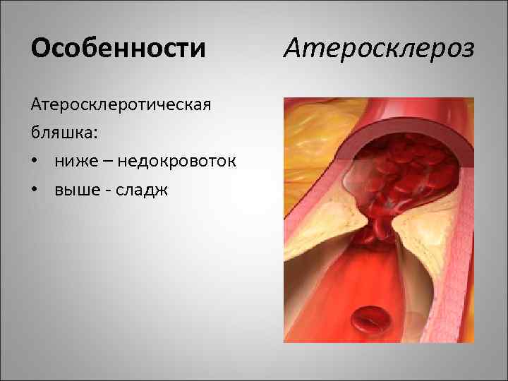 Особенности Атеросклероз Атеросклеротическая бляшка: • ниже – недокровоток • выше - сладж 