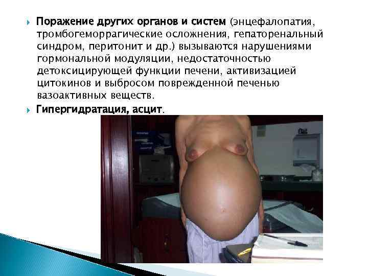  Поражение других органов и систем (энцефалопатия, тромбогеморрагические осложнения, гепаторенальный синдром, перитонит и др.