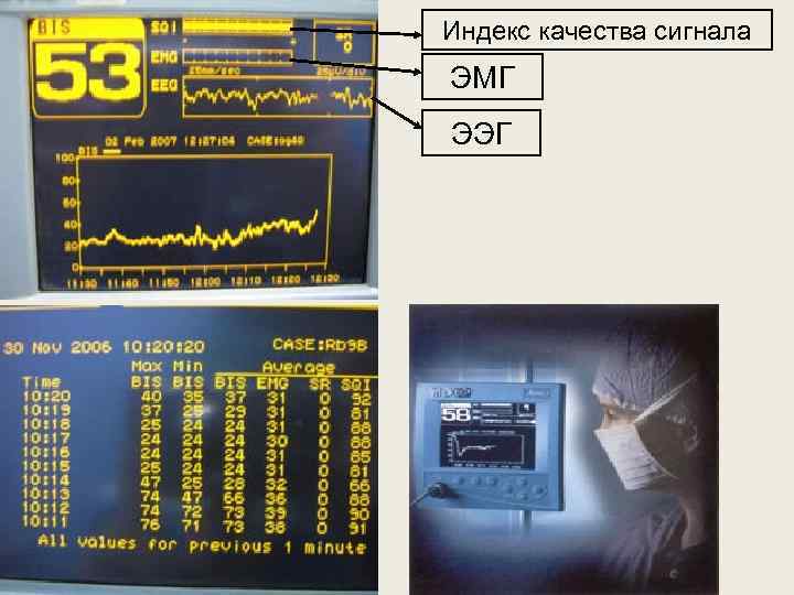 Индекс качества сигнала ЭМГ ЭЭГ 