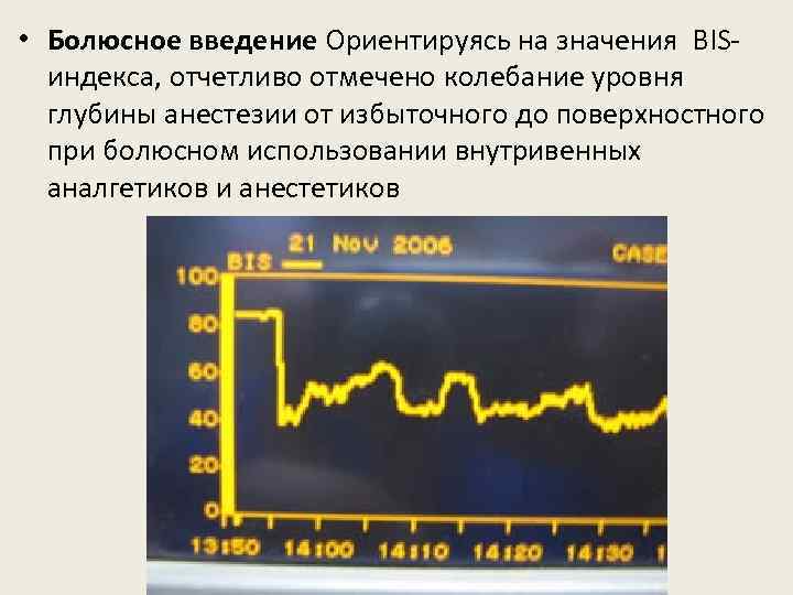  • Болюсное введение Ориентируясь на значения BISиндекса, отчетливо отмечено колебание уровня глубины анестезии