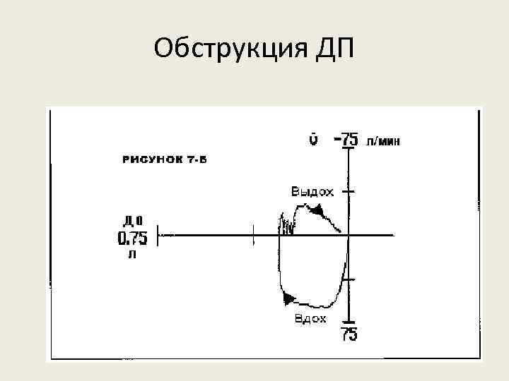 Обструкция ДП 