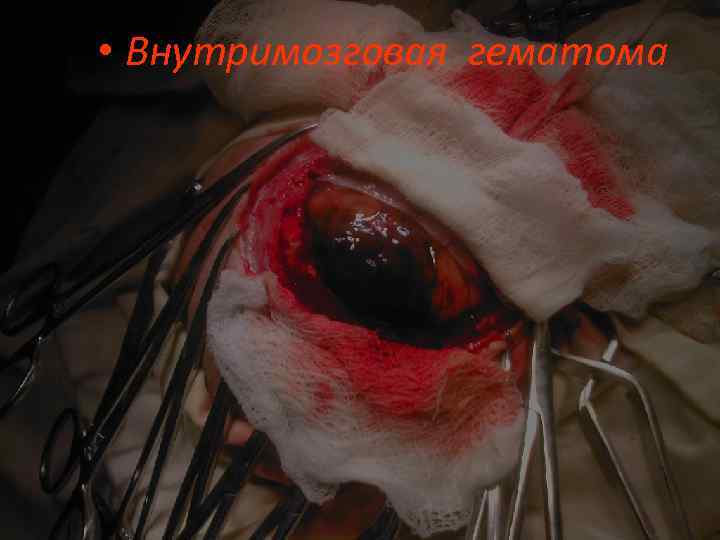  • Внутримозговая гематома 