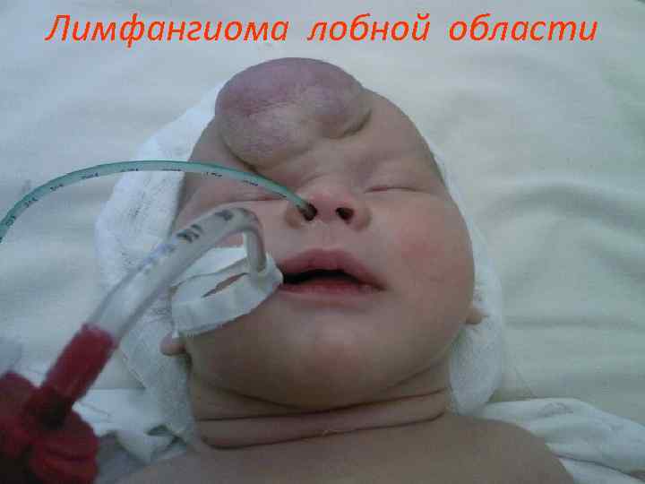 Лимфангиома лобной области 