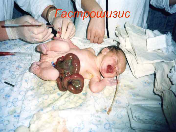 Гастрошизис 