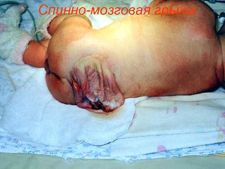 Спинно-мозговая грыжа 