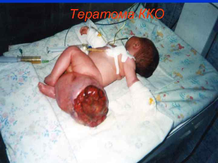 Тератома ККО 