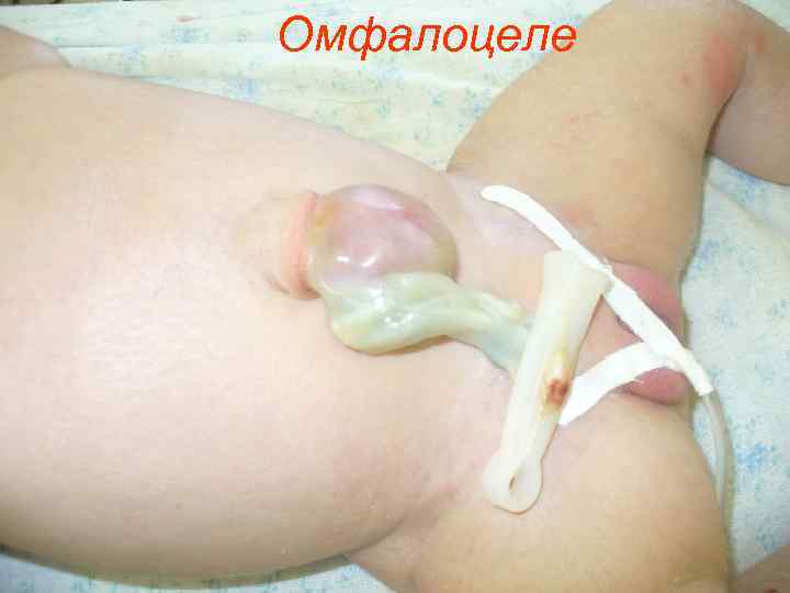 Омфалоцеле 
