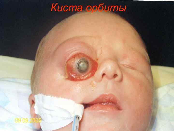 Киста орбиты 