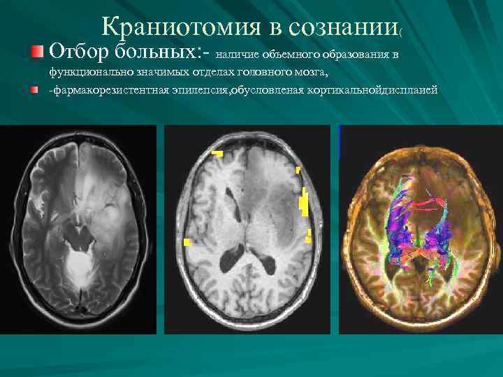 Краниотомия в сознании ( Отбор больных: - наличие объемного образования в функционально значимых отделах