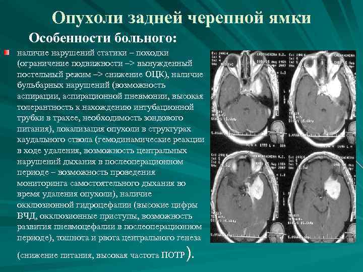 Опухоли задней черепной ямки Особенности больного: наличие нарушений статики – походки (ограничение подвижности –>