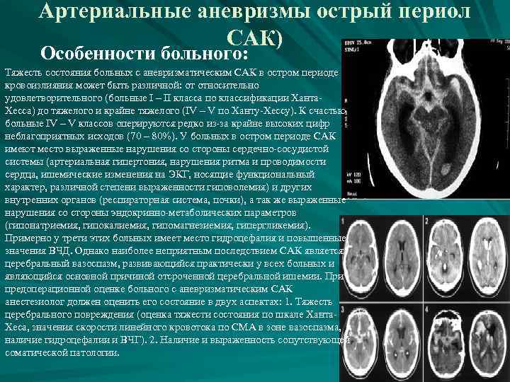 Артериальные аневризмы острый периол САК) Особенности больного: Тяжесть состояния больных с аневризматическим САК в