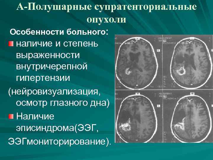 А-Полушарные супратенториальные опухоли Особенности больного: наличие и степень выраженности внутричерепной гипертензии (нейровизуализация, осмотр глазного