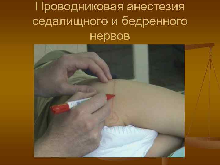 Проводниковая анестезия седалищного и бедренного нервов 