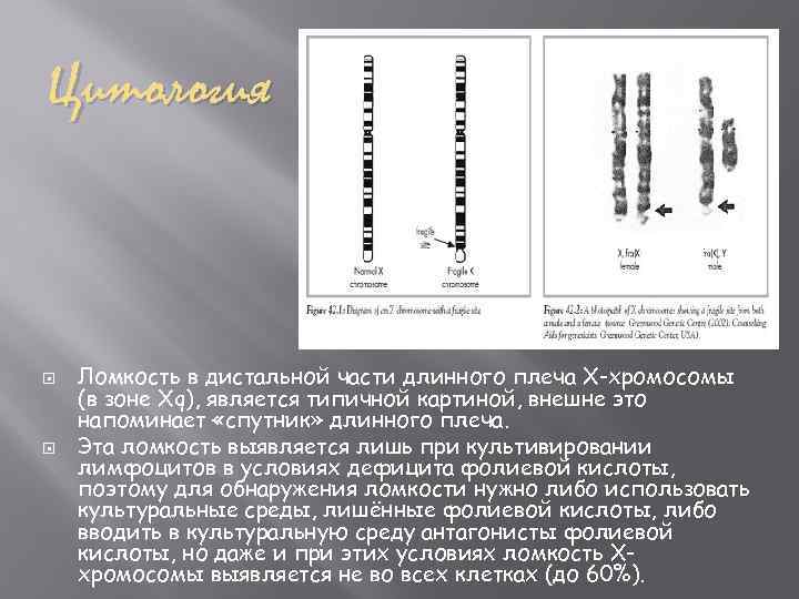 Цитология Ломкость в дистальной части длинного плеча Х-хромосомы (в зоне Xq), является типичной картиной,