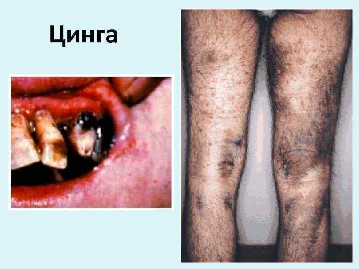 Цинга 