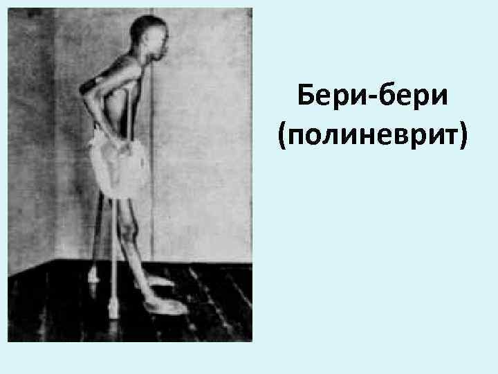 Бери-бери (полиневрит) 