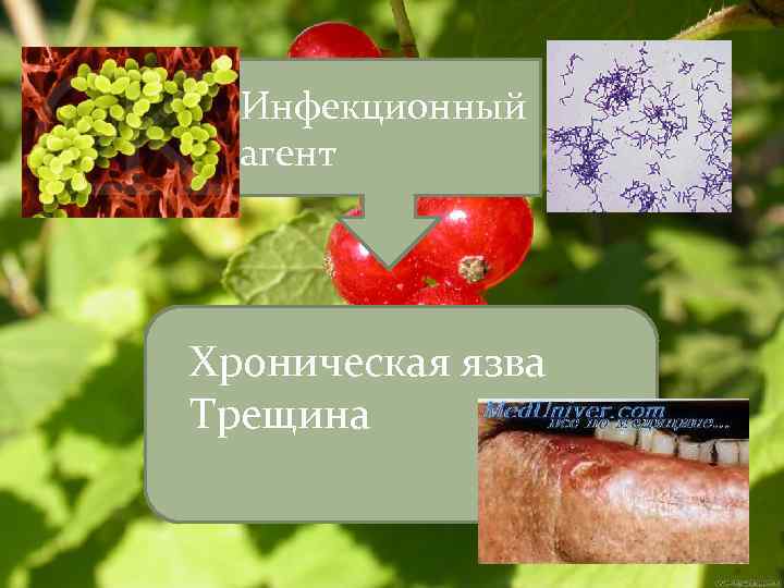 Инфекционный агент Хроническая язва Трещина 