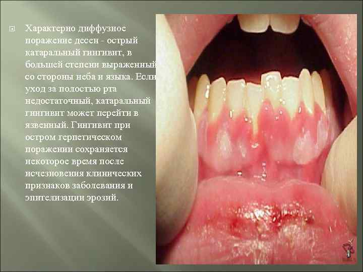  Характерно диффузное поражение десен - острый катаральный гингивит, в большей степени выраженный со