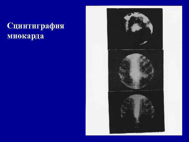 Сцинтиграфия миокарда 