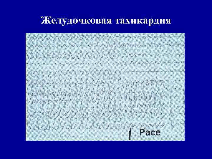 Желудочковая тахикардия 