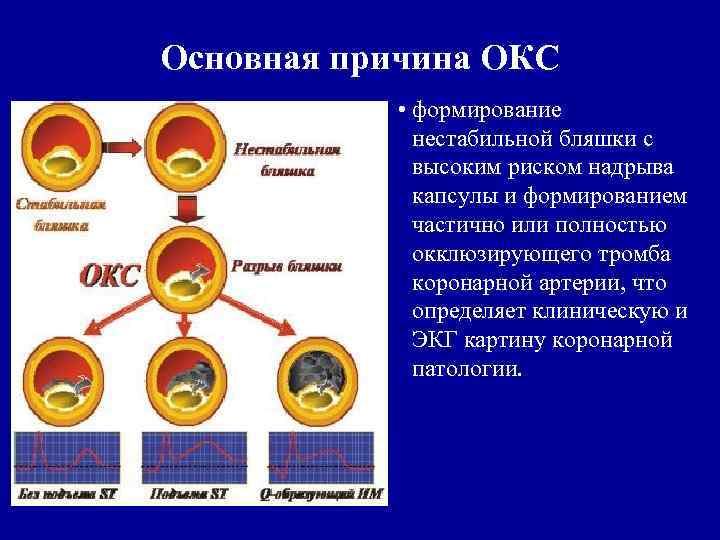 Основная причина ОКС • формирование нестабильной бляшки с высоким риском надрыва капсулы и формированием