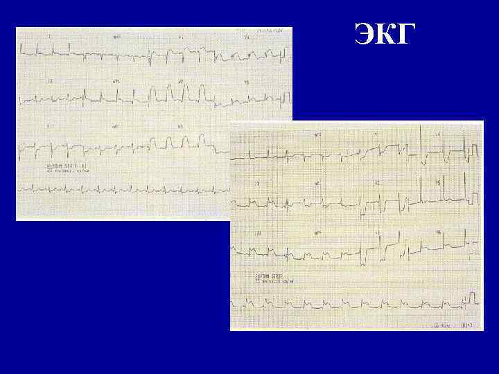 ЭКГ 