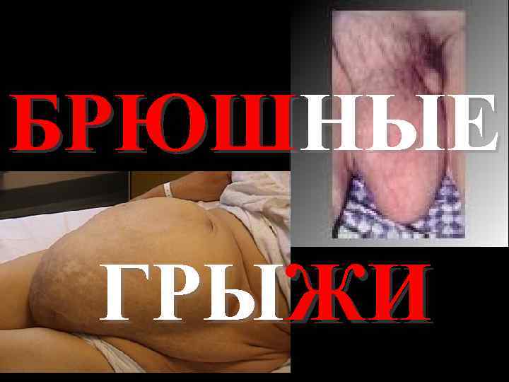 БРЮШНЫЕ ГРЫЖИ 