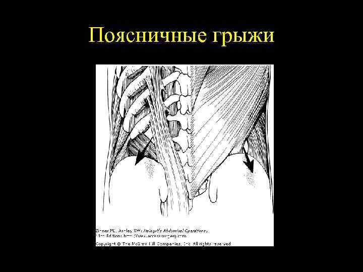 Поясничные грыжи 