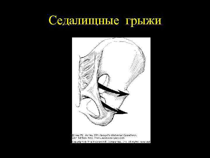 Седалищные грыжи 